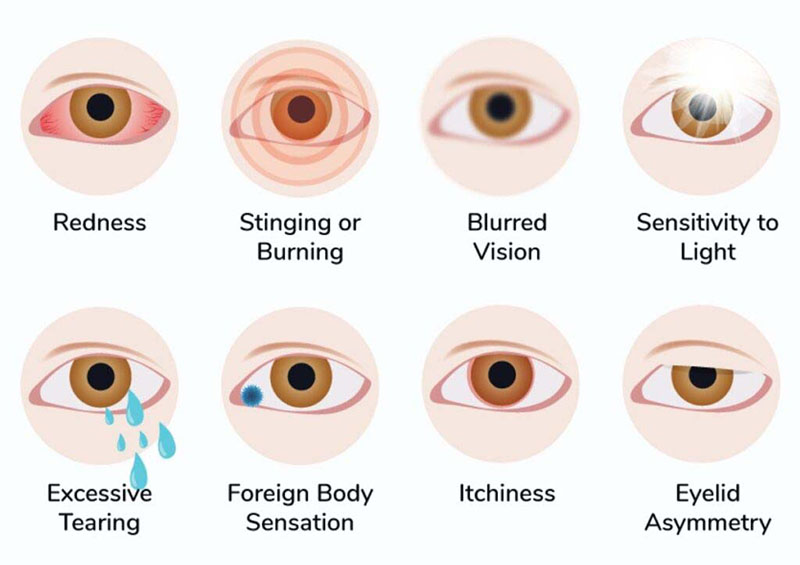 Dry eye symptoms