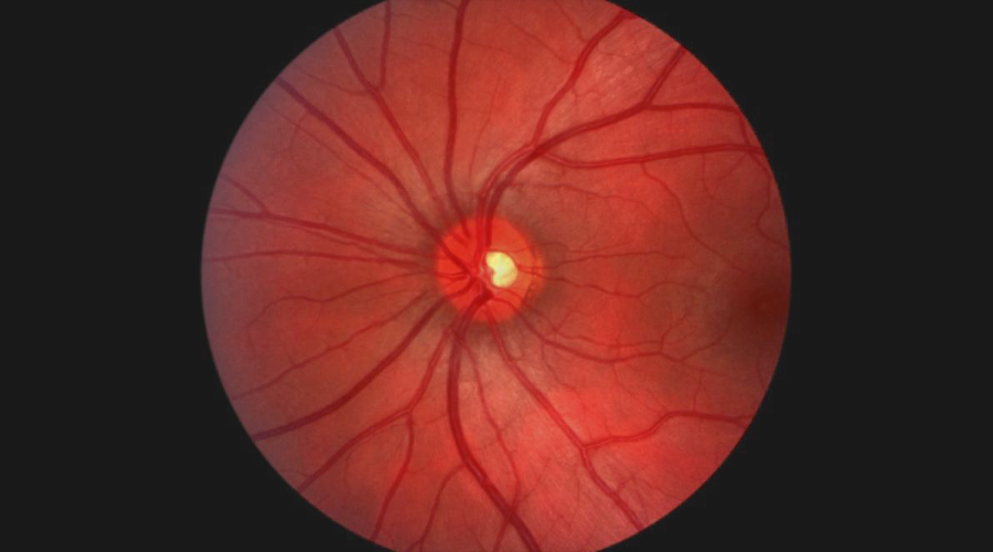 Advanced Eye Imaging to Detect Common Eye Diseases