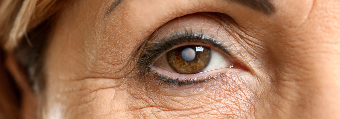 Woman with cataracts